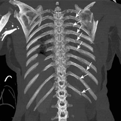 Rib fracture - WikEM