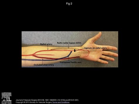 Distal Revascularization And Interval Ligation Procedure For Radial