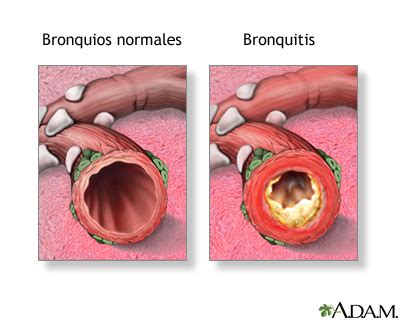 Apuntes De Neumologia Bronquitis Aguda