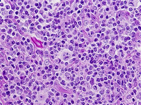 Pathology Outlines - Nodular lymphocyte predominant