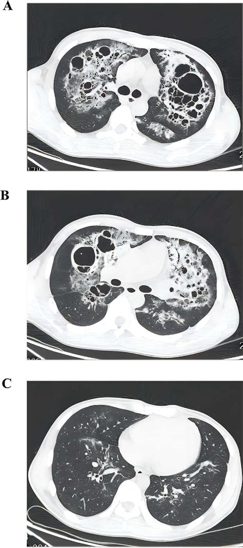 Figure 1 From Misdiagnosis Diagnosis Of Pneumocystis Pneumonia As Chemical Pneumonitis