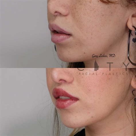 NYC Philtrum Contouring Lip Lift | Dr. Gary Linkov Facial Plastic Surgeon