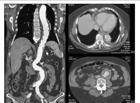 Figure 2 from Acute aortic dissection: a case report showing ...