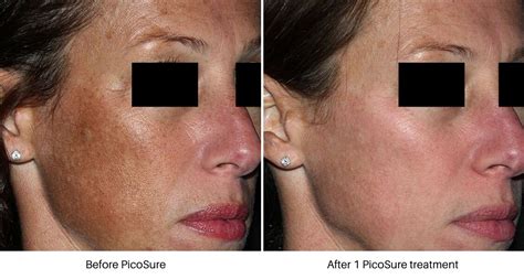 Laser Skin Resurfacing In Chatham