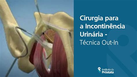 Cirurgia Para A Incontin Ncia Urin Ria T Cnica Out In Youtube