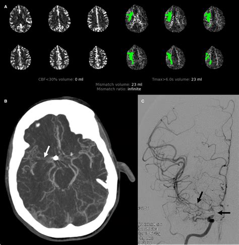 Diagnostic Performance Of Computed Tomography Angiography And Computed