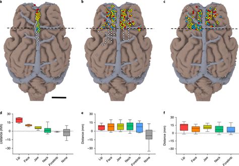 Somatotopy Of Endovascular Subdural And Penetrating Cortical