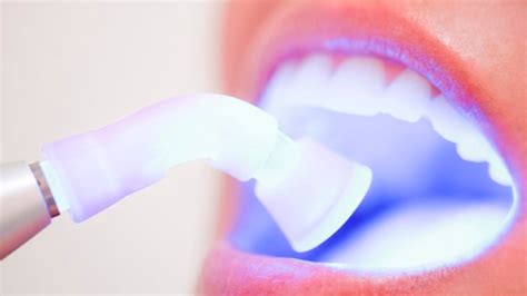 Clareamento dental o que você precisa saber antes de realizar