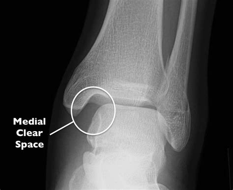 Understanding the Diagnosis of a High Ankle Sprain