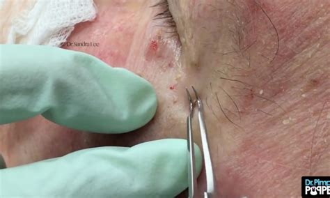 Dr Pimple Popper Ingrown Hair