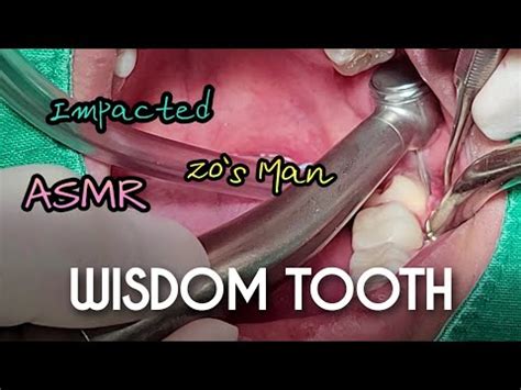 ASMR Impacted Wisdom Tooth Extraction 4k Wisdomtooth YouTube