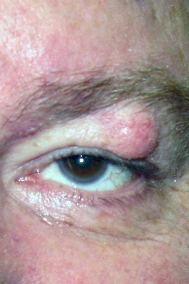 Soft Bump On Eyelid