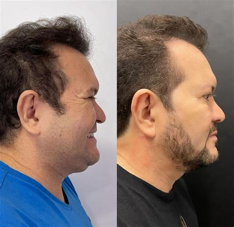 Not Cias Ximbinha Mostra Antes E Depois De Cirurgia Facial Agora T