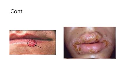 infective stomatitis pptx