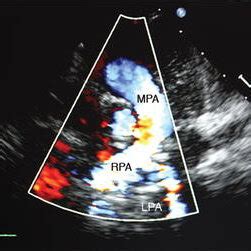 Transthoracic Echocardiogram Showing Main Pulmonary Artery MPA Giving