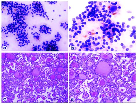 Cytology And Histomorphology Suggestive Of Follicular Carcinoma Download Scientific Diagram