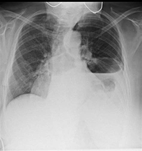 Hiatus hernia CT - wikidoc