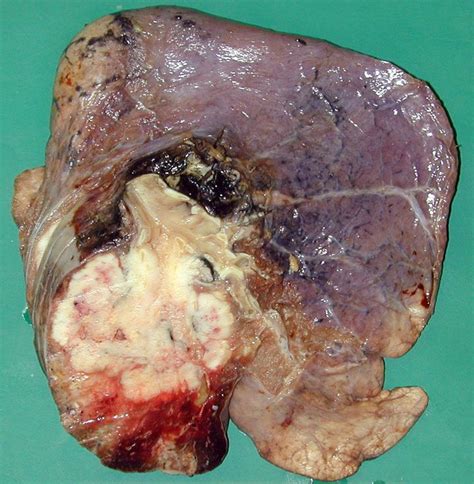 NON SMALL CELL LUNG CANCER NSCLC MEDizzy