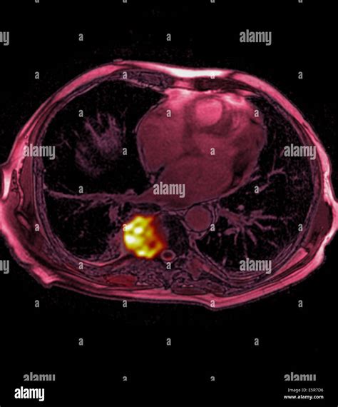 Lung Cancer Mri