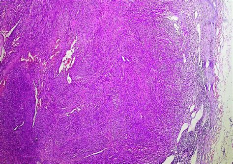 Figure 4 From Kaposis Sarcoma With Primary Lymph Node Involvement In A