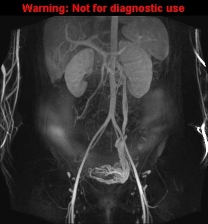 Pelvic Congestion On Ultrasound