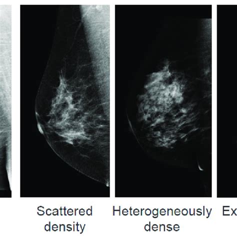 American College Of Radiology Breast Imaging Reporting And Data System