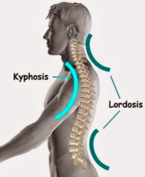 Lordosis and Spine Surgery- Like Two Peas in a Pod - Rocky Mountain ...