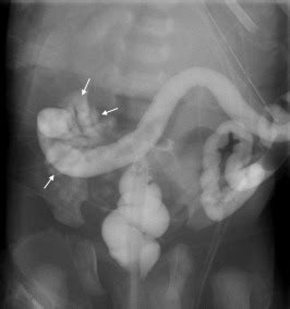 Diagnostic Decision Making Tool For Imaging Term Neonatal Bowel