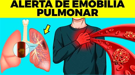 S Ntomas De Alarma De Embolia Pulmonar Youtube