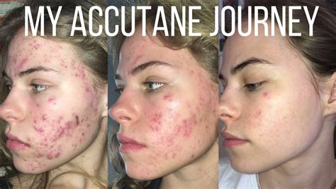 How I Cleared My Acne Accutane Skincare And More Youtube