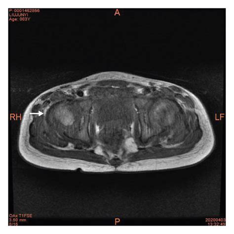 T1 Weighed T2 Weighed And Fat Suppressed T2 Weighted Imaging In The