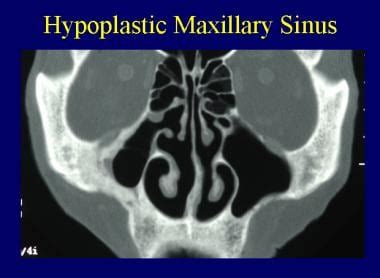 Surgical Treatment Of Chronic Maxillary Sinusitis Surgical Overview