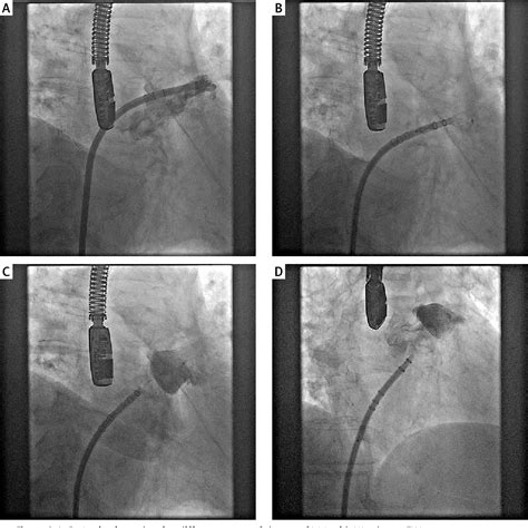 Figure From The Watchman Flx A New Device For Left Atrial Appendage