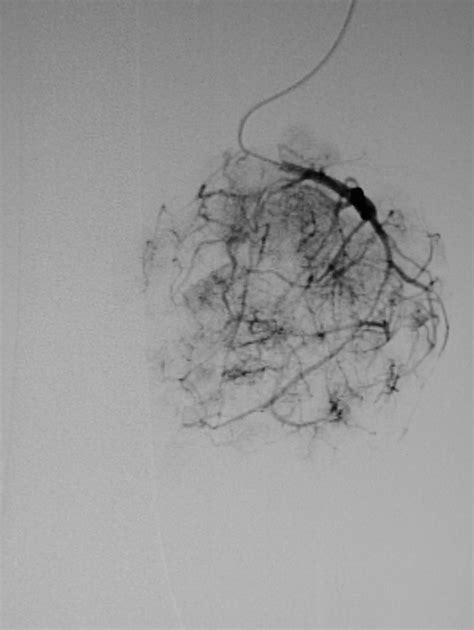 Preoperative Embolization Case Albany Ir