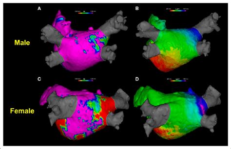 Representative Left Atrial Electroanatomic Maps In Male And Female