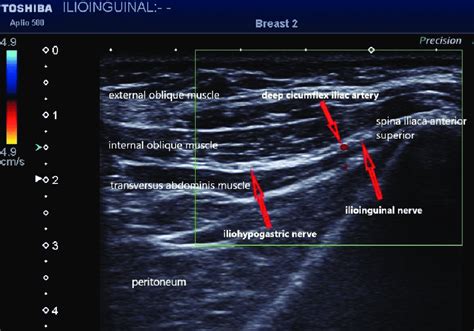 Ilioinguinal Nerve Block Ultrasound