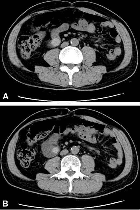 Figure 2 From Gallstone Ileus Successfully Treated With Endoscopic