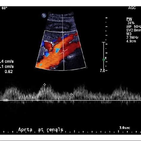 Case 1. Abnormal parvus tardus Doppler spectral waveform from the aorta ...