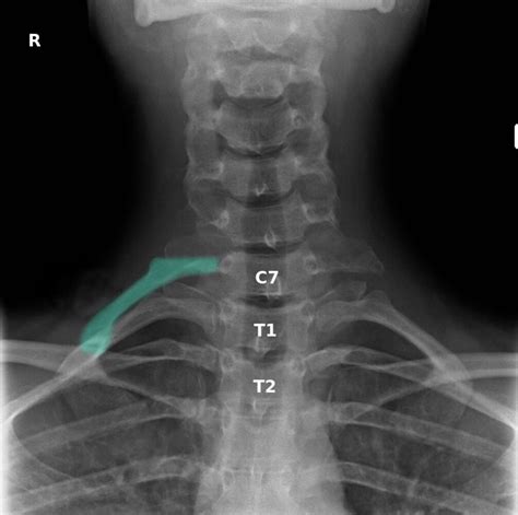 Radiologytidbits — Thoracic Outlet Syndrome Can Be Caused By Cervical