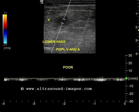 cochinblogs: Ultrasound imaging of popliteal vein thrombosis