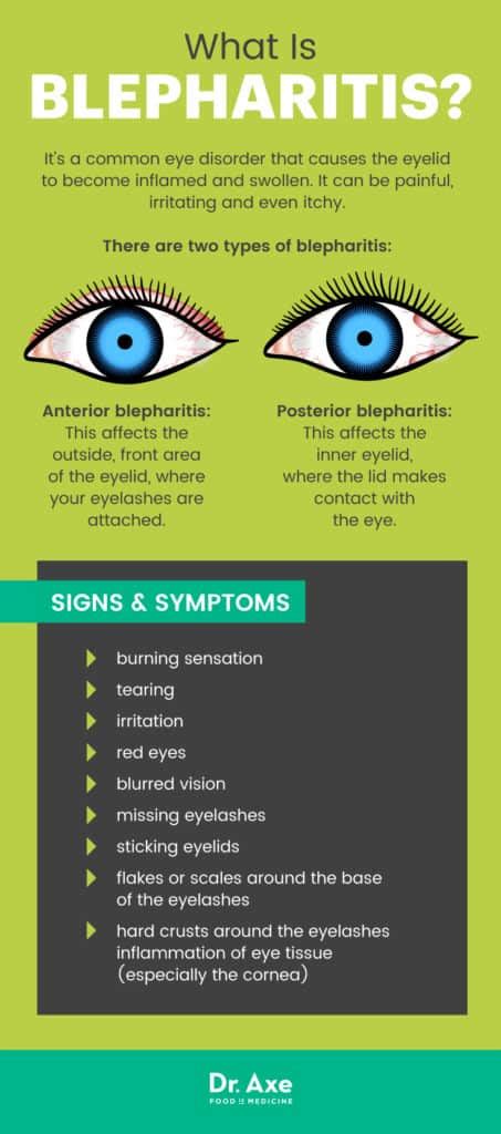 Blepharitis 7 Natural Treatments To Soothe An Inflamed Eyelid Dr Axe