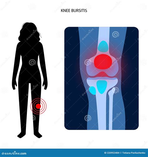 Knee Bursitis Superficial Infrapatellar Bursitis Cartoon Vector