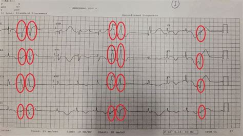 สูงอายุ ใจสั่น EKG มีแค่ PVC – Front-line EKG