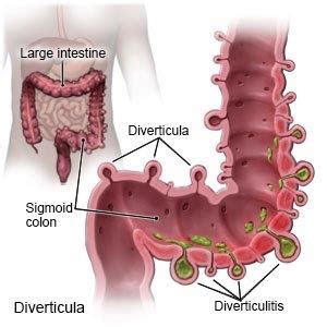 Imaging For Diverticulitis Ultrasound Solutions Corp