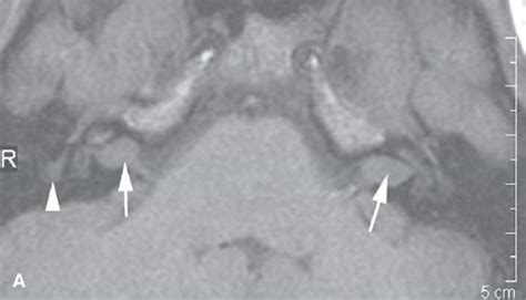 Benign And Malignant Peripheral Nerve Sheath Tumors Radiology Key