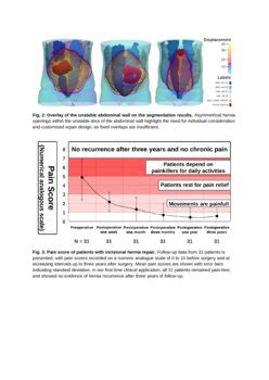 HEDI First Time Clinical Application And Results Of A Biomechanical