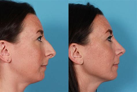 Deviated Septum Nose Job Surgery