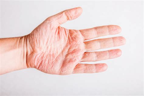 Pustular Psoriasis | A Rare Form of Psoriasis