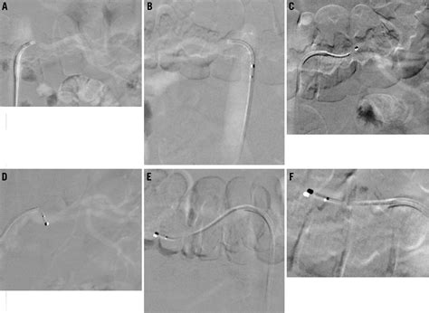 Renal Denervation Tips And Tricks To Perform A Technically Successful Procedure Eurointervention