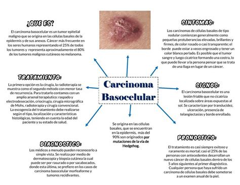 Carcinoma Basocelular Infosalud Iyg Udocz